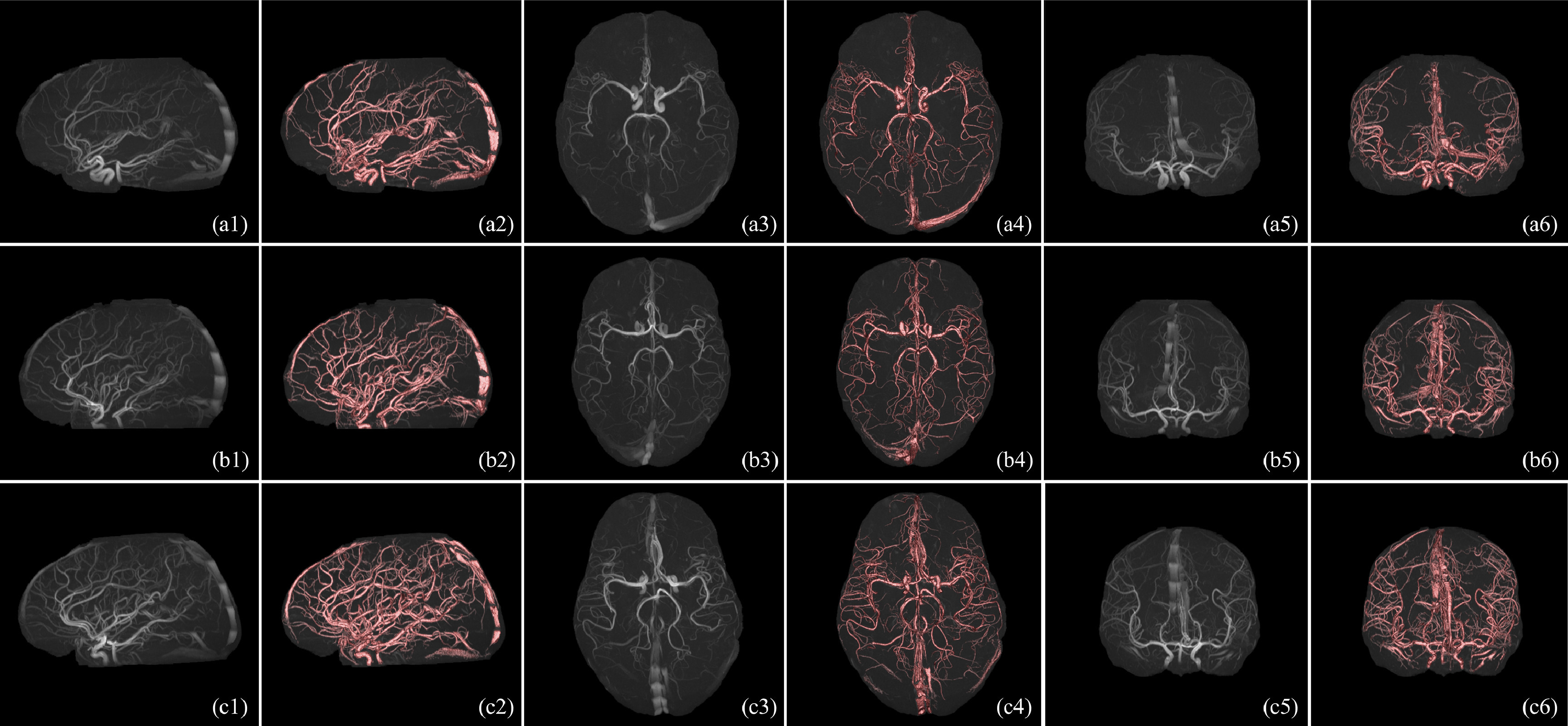 Vessel Segmentation and Geometry Analysis for Stenosis Detection picture